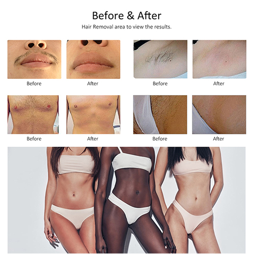 AresMix Professional Diode Laser Hair Removal Machine