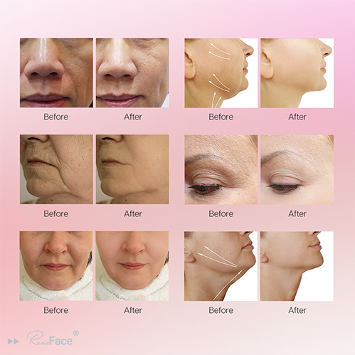 Renaface Ems Face Machine