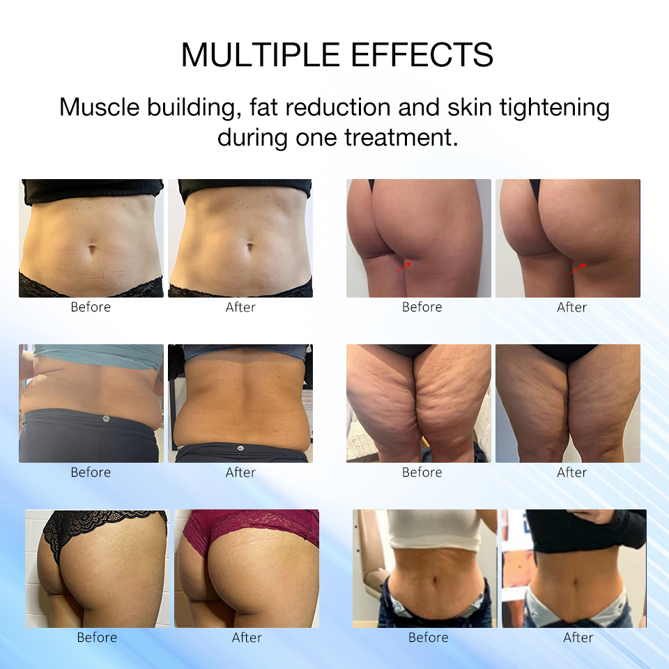 Renasculpt Emslim Professional Body Contouring Machine