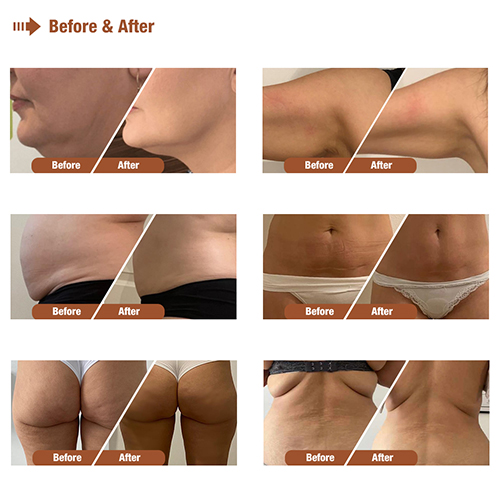 Best 40K Ultrasonic Cavitation Body Shape Machine 5 in 1