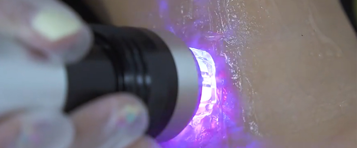 microneedle treatment