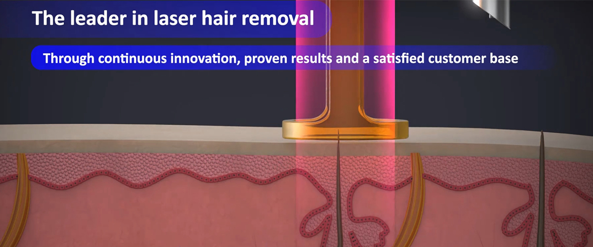 1064 nd yag hair removal machine