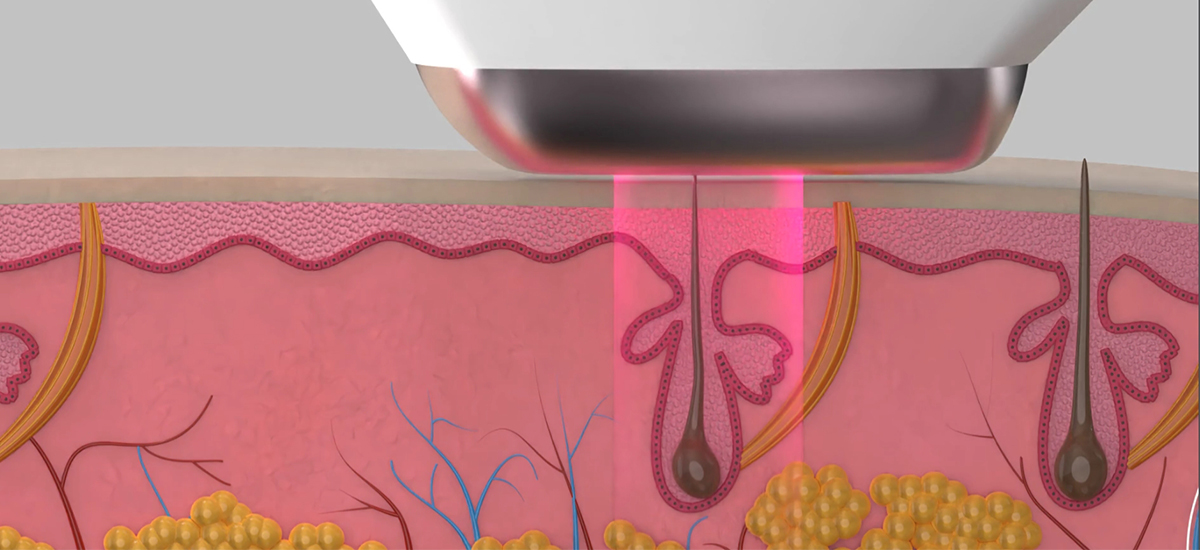 diode laser principle