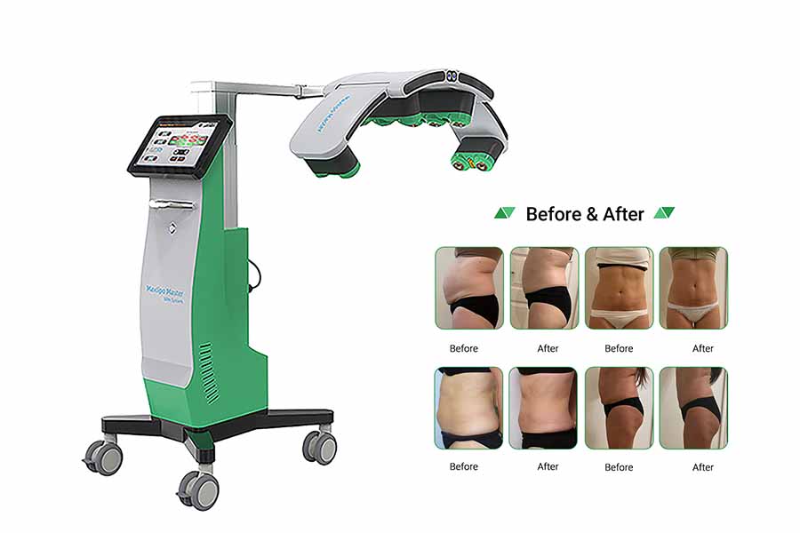 10d laser lipo