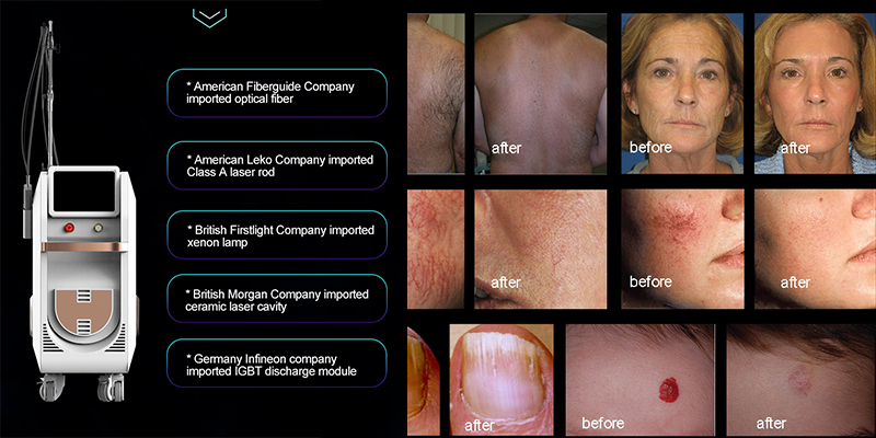 alexandrite laser machine